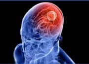 Pemkab Bojonegoro Ajak Warga Waspadai Tumor Otak Sejak Dini