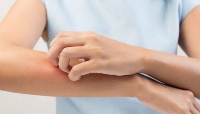 Cegah Penyakit Kusta, Ini Gejala dan Pengobatannya